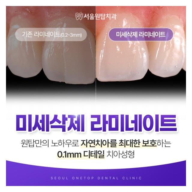 미세삭제 라미네이트로 자연스러운 미소를 찾아드립니다.
